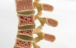 <strong>Osteoporosis: Un Cambio de Paradigma.</strong>